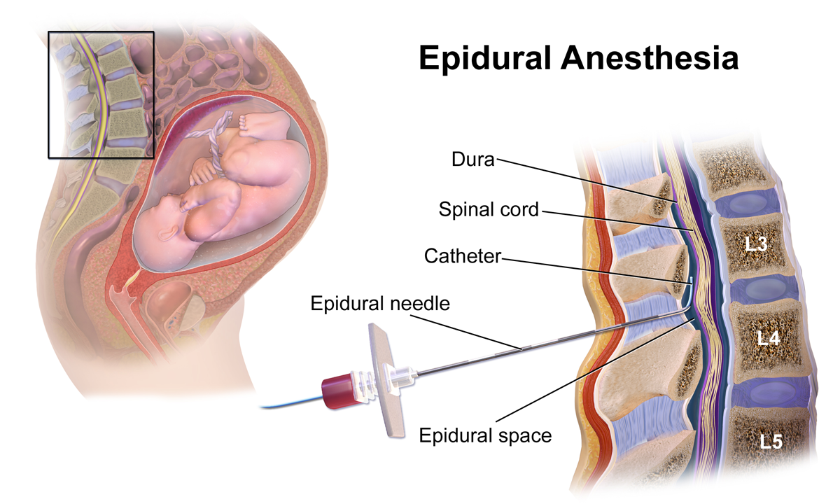 anestesi_epidural